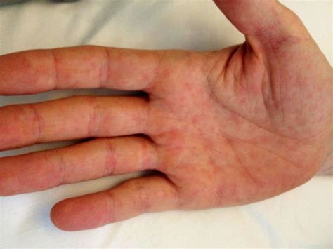 Differential Diagnosis Of A Palmar And Plantar Rash The Bmj