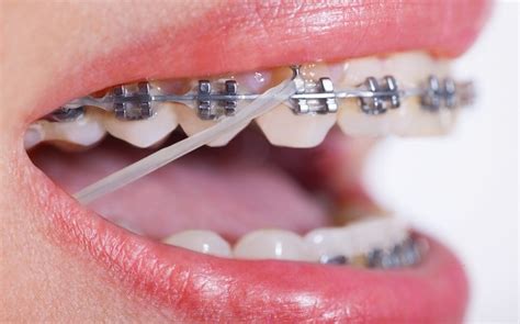 insights on orthodontic treatment healthy b daily