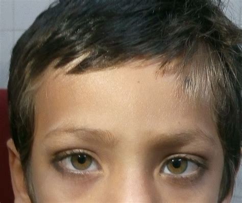White Lock Of Hair With Heterochromia Spot Diagnosis Pediatric Oncall