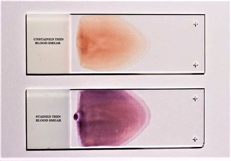 Giemsa Staining Technique Principle Preparation Procedure And Results