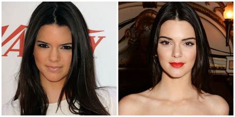 Kendall Jenner Botox And Lip Injections Botox Before And After