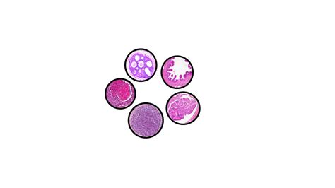 Ductal And Lobular Carcinoma In Situ Breast Pathology Made Simple