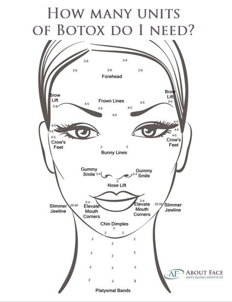 printable botox injection face map