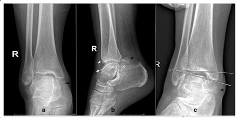 The Radiographs Of Right Ankle A Anteroposterior Weight Bearing View