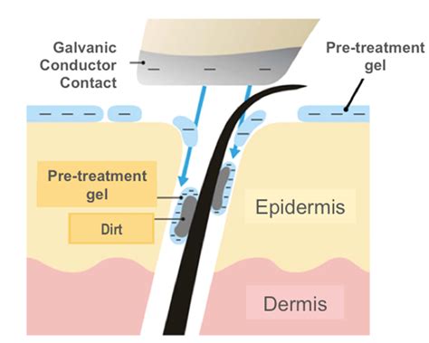 Galvanic treatment is used to improve the appearance of the skin and is said to provide a quick and effective rejuvenation galvanic treatment is an aesthetic treatment used to achieve a rapid facial. Galvanic Current Gallery