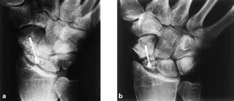 Figure 1 From Definition Of Union After Acute Fracture And Surgery For