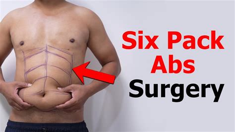 Six Pack Abs Surgery Six Pack Abs Surgery Result Liposuction Cost Liposuction Result Youtube