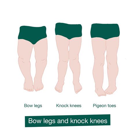 Bow Legs And Knock Knees In Children Hseie