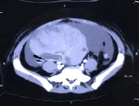 Axial Contrast Enhanced Ct Pelvisshows Large Right Ovarian Mass With