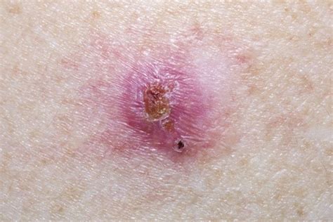 10 Deadly Signs Of Skin Cancer You Need To Spot Early Page 3 Health