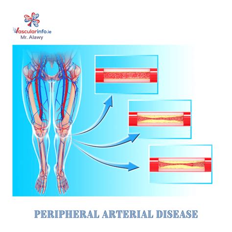 Peripheral Arterial Disease Vascular Info
