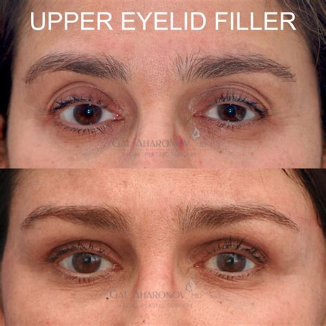 Upper Eyelid And Undereye Filler Plastic Surgery