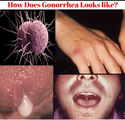 what gonorrhea looks like pictured public health