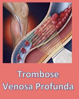 Find and follow posts tagged trombose on tumblr. TROMBOSE: PREVENIR É O MELHOR REMÉDIO