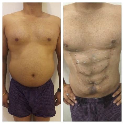 Six Pack Abs Surgery Abs Creation Surgeon In Gurgaon Delhi Ncr