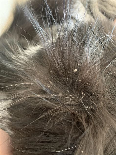 Dandruff on cat? No itching or discomfort that I can notice : CATHELP