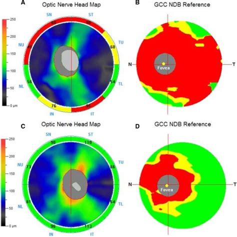 Spectral Domain Optical Coherence Tomography Shows The Optic Nerve Head