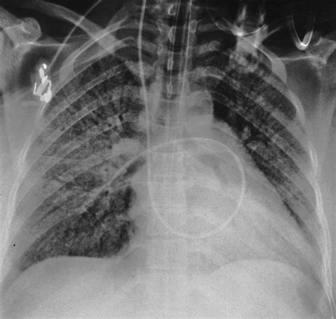 Clinical And Radiologic Features Of Pulmonary Edema Radiographics