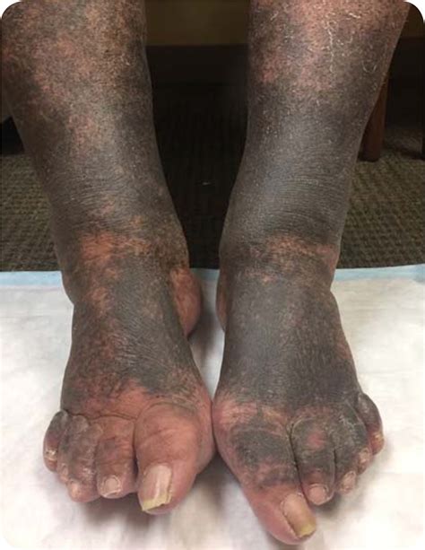 Bilateral Lower Extremity Discoloration Aafp