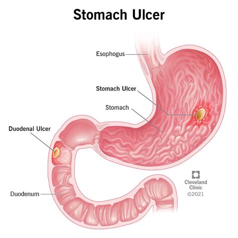 Stomach Peptic Ulcer Signs Symptoms Causes Treatment