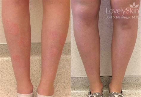 Psoriasis Before And After Photos Skin Specialists Pc Lovelyskin