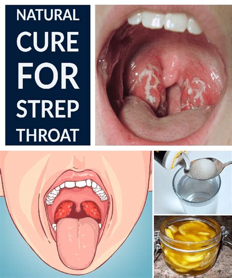 Treatment For Strep Throat Philadelphia Holistic Clinic Dr Tsan And Assoc