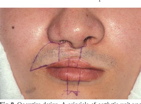 Figure 2 From Reconstruction Of Wide Cleft Lip Scar By Abbe Flap And Advancement Flap From