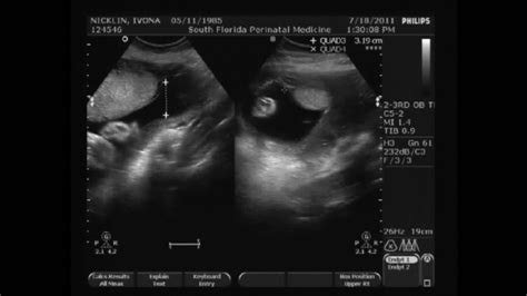 29 Weeks Pregnant Ultrasound Youtube