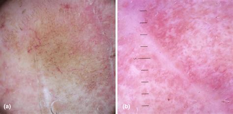 A One Month Post‐surgical Picture Dermoscopy Shows Persisting