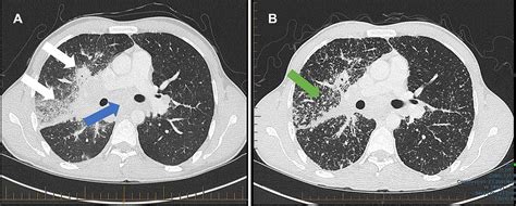 Cureus Tuberculosis And Sarcoidosis Overlap A Clinical Challenge