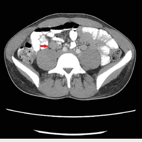 Axial Image From Ct Of The Abdomen And Pelvis With Oral And Iv Contrast
