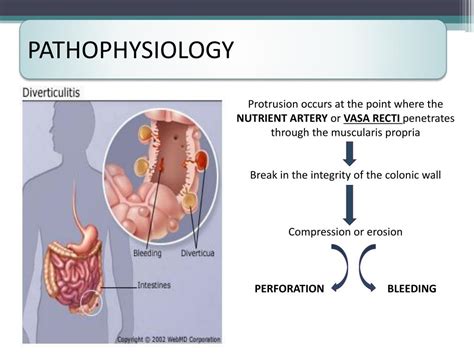 Ppt Colonic Diverticular Disease Powerpoint Presentation Free