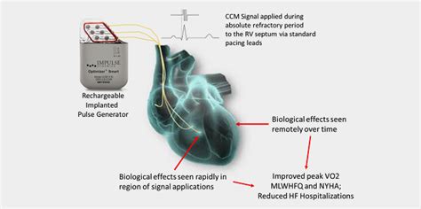 Fda Approves The Optimizer Smart Implantable Pulse Generator For Heart
