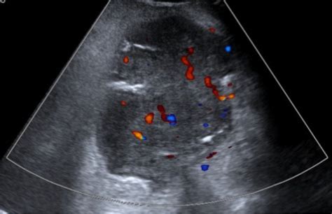 Ultrasound For Giant Abdomen Liposarcoma One Case Report Diao