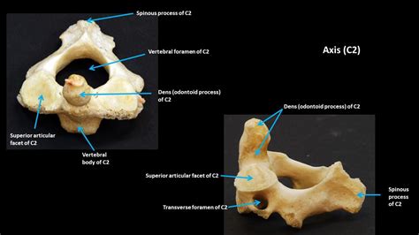 Axis Vertebrae Anatomy