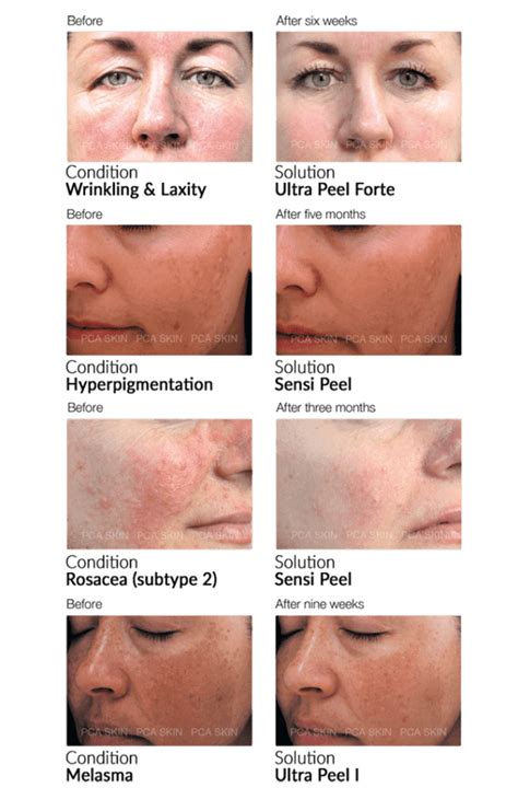 Juvly Aesthetics Pca Peels For Firm And Skin Tightening