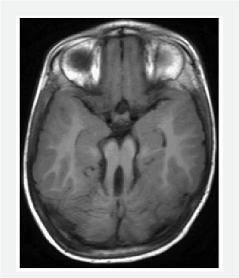 Joubert Syndrome Axial Mri Of A 5 Year Old Boy With Delayed
