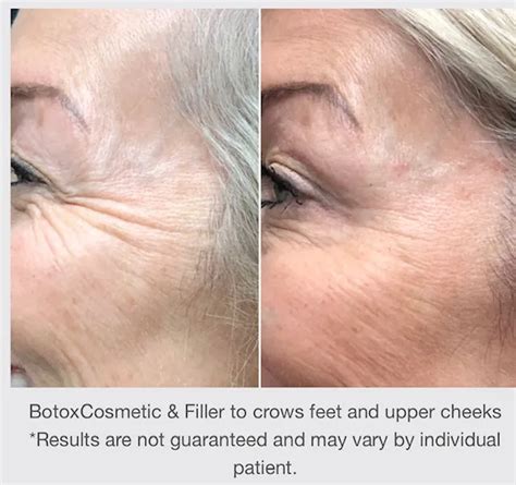 Botox Winnipeg Dr Minuk Cosmetic Skinclinic