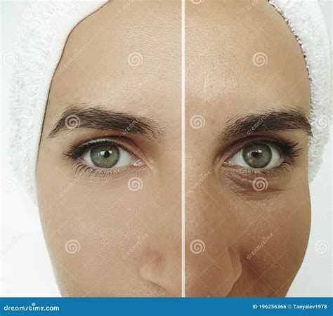 Woman Caucasian Face Aging Rejuvenation Cosmetology Removal Wrinkles Before And After Treatment