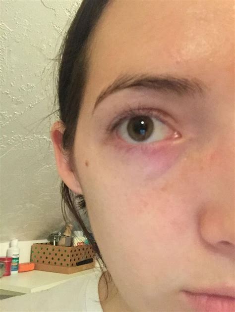 Skin Concern Is It Even Possible To Get Rid Of Pink Purple Under Eyes