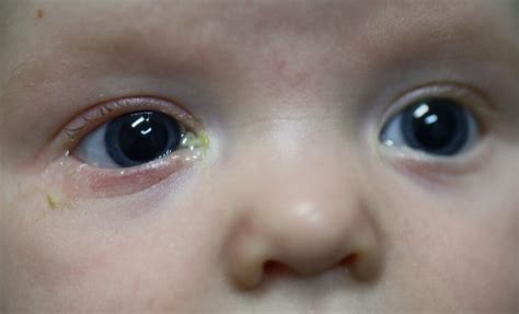 Blocked Tear Duct In Infants Causes Symptoms Diagnosis Treatment