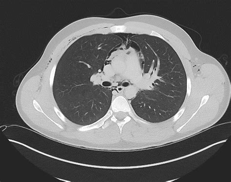 Four Cases Of Pneumomediastinum European Respiratory Society