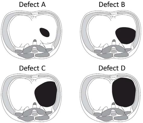Thoracoscopic Patch Repair Of Congenital Diaphragmatic Hernia Can