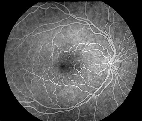 Fluorescein Angiography Department Of Ophthalmology And Visual Sciences
