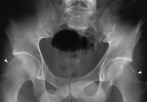 Adult Chronic Hip Pain Radiographic Evaluation Radiographics