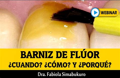 Barniz De FlÚor ¿cuando ¿cómo Y ¿porqué Dra Fabiola Simabukuro