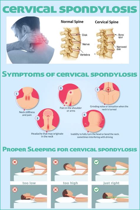 Cervical Spondylosis Symptoms Management And Treatment