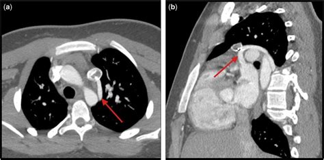 Contrast Enhanced Ct In Patient 2 10 Years After The Procedure Ct