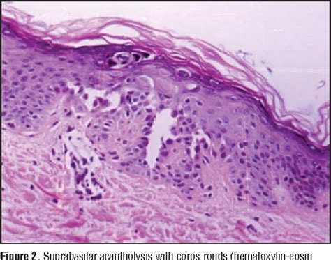 Figure 2 From Clinical And Dermoscopic Features Of Porokeratosis Of