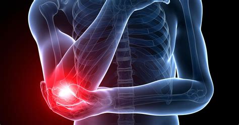 Tennis elbow is a classic repetitive strain injury (rsi): Exercise a More Effective Treatment for Tennis Elbow ...